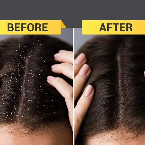 Anti-Dandruff - Image 1