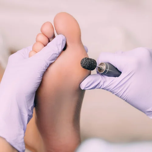 Relaxing foot soak and gentle callus removal process